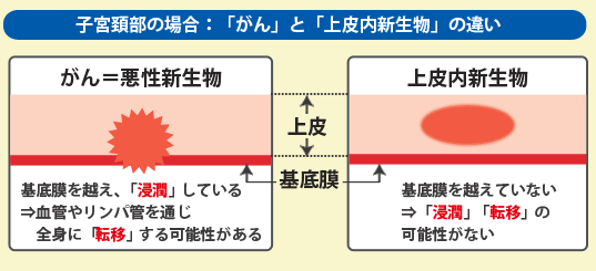 上皮 内 新 生物